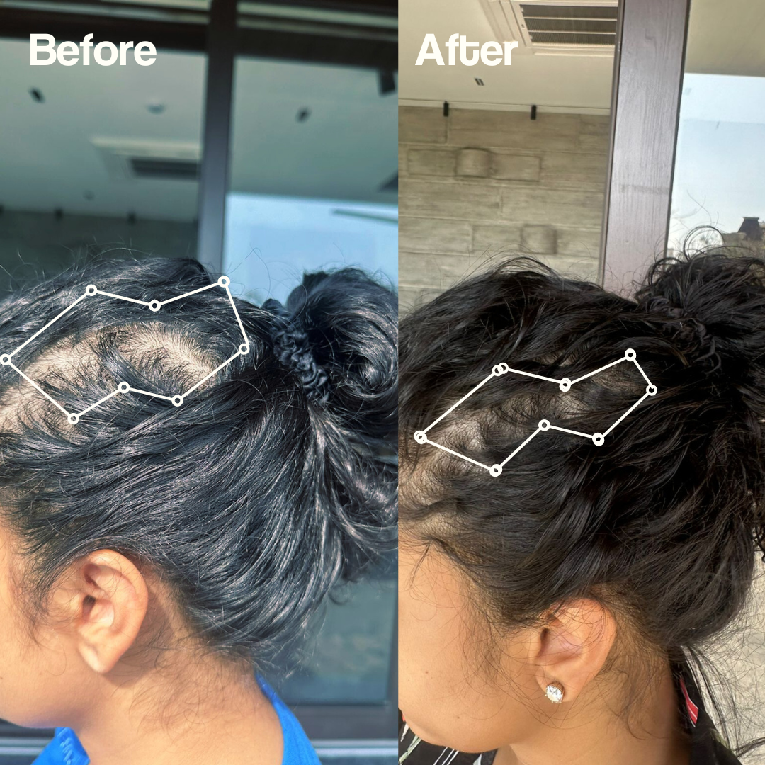 Hair Regrowth Kit